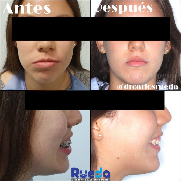 Casos De Ortodoncia Centro Dental Rueda 9466